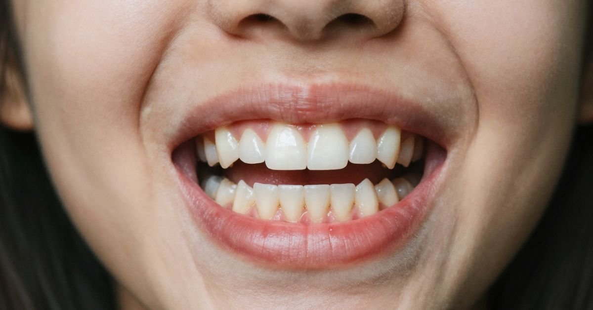 How to Fix Overbite