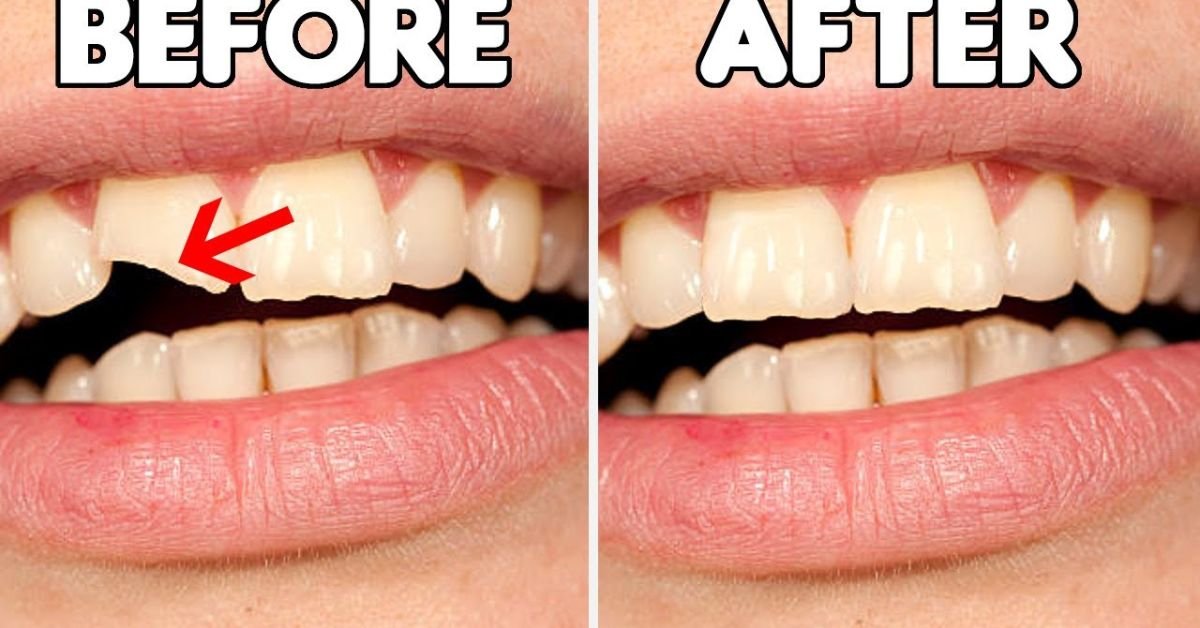 How to Fix a Cracked Tooth Naturally
