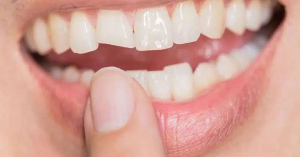 What Causes a Cracked Tooth