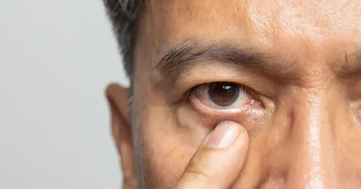 how to fix lazy eye