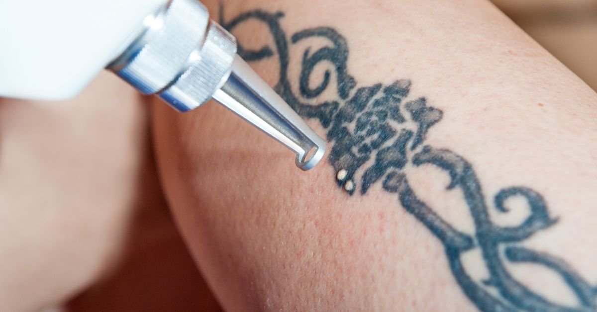 how to remove tattoo